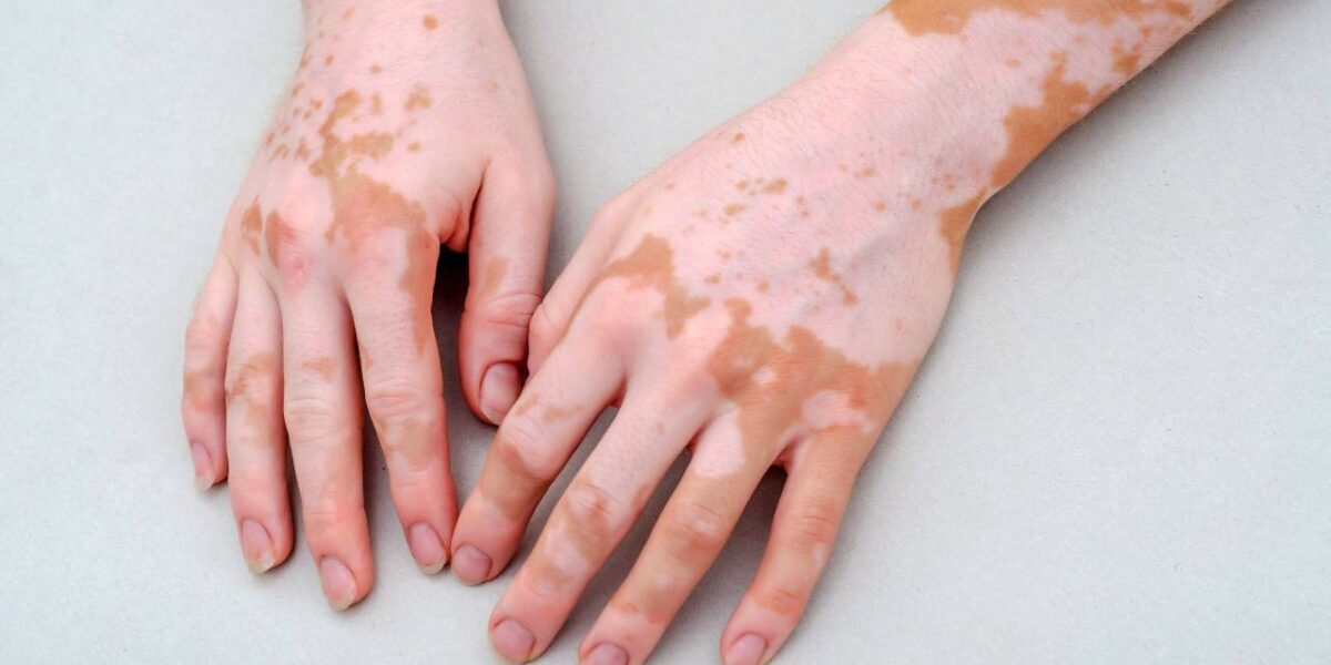 Fapeg e UFG desenvolvem fitoterápico para combater o vitiligo