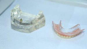 Novo sistema para fixar dentadura