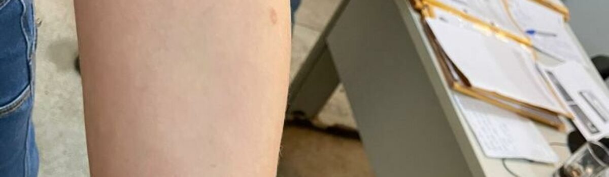 Homem é preso por queimar namorada menor de idade com óleo quente