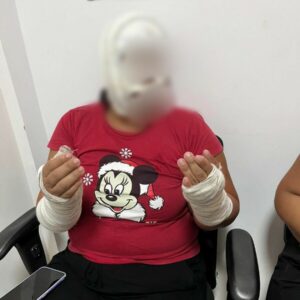 Polícia Civil prende companheiro que jogou água quente no rosto e braço de vítima, em Anápolis, causando-lhe queimaduras