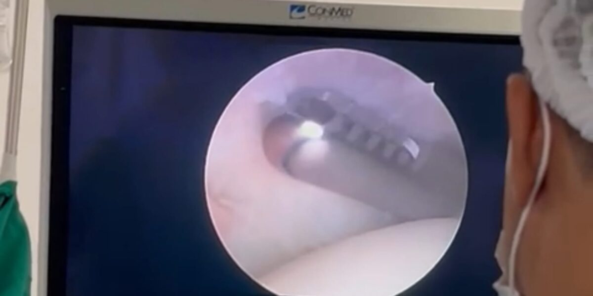 HCN realiza 1ª cirurgia com alta tecnologia por vídeo no centro-note do Estado